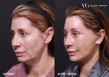 Facelift before and after results at VG Plastic Surgery – visible facial rejuvenation after 1 week