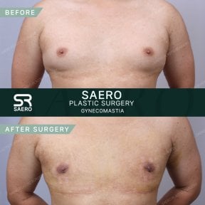 Before and after gynecomastia surgery results at SAERO Plastic Surgery, male chest contouring