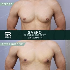 Before and after gynecomastia surgery results at SAERO Plastic Surgery, male chest contouring