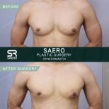 Before and after gynecomastia surgery results at SAERO Plastic Surgery, male chest contouring