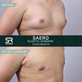 Before and after gynecomastia surgery results at SAERO Plastic Surgery, chest contour improved