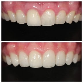 Before and after veneers results at Dentist at home, Bangkok – improved smile aesthetics