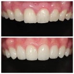 Before and after veneers results at Dentist at home, Bangkok – improved smile aesthetics