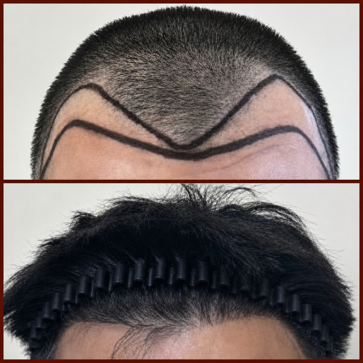 قبل وبعد زراعة الشعر في عيادة DGB – استعادة خط الشعر وكثافة الشعر