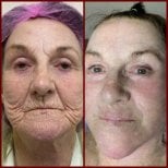 Resultados antes y después de lifting de cuello en DGB Clinic, rejuvenecimiento facial visible