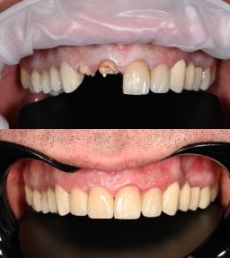قبل وبعد تركيب تيجان الزركونيا في عيادة Unident – نتيجة ابتسامة مستعادة