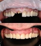 قبل وبعد تركيب تيجان الزركونيا في عيادة Unident – نتيجة ابتسامة مستعادة