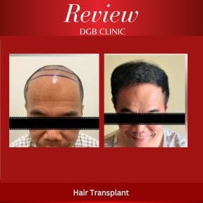 Before and after hair transplant results at DGB Clinic, restored hairline and fuller hair
