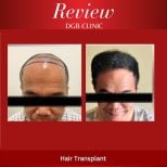 Before and after hair transplant results at DGB Clinic, restored hairline and fuller hair