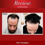 Before and after hair transplant results at DGB Clinic, improved hairline and density