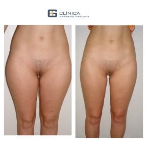 Before and after liposculpture results at Clinica Granado Tiagonce, improved body contour