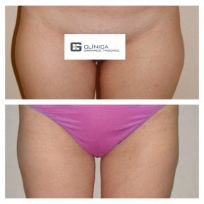 Before and after liposculpture results at Clinica Granado Tiagonce, improved thigh contour