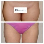 Before and after liposculpture results at Clinica Granado Tiagonce, improved thigh contour