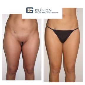 Before and after liposculpture results at Clinica Granado Tiagonce, improved body contour
