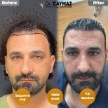 Resultado de trasplante capilar Sapphire FUE, 4300 injertos en la clínica Dr. Erkam Caymaz