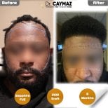 Resultado de trasplante capilar Sapphire FUE antes y después en Dr. Erkam Caymaz