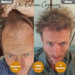 Resultado de trasplante capilar Sapphire FUE antes y después en Dr. Erkam Caymaz