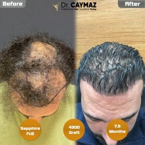 Resultado de trasplante capilar Sapphire FUE en Dr. Erkam Caymaz, 4300 injertos, 7.5 meses