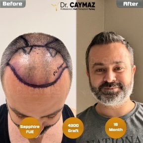 Resultado de trasplante capilar Sapphire FUE antes y después en Dr. Erkam Caymaz