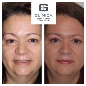 Before and after mini facelift results at Clinica Granado Tiagonce, facial rejuvenation visible