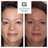 Before and after mini facelift results at Clinica Granado Tiagonce, facial rejuvenation visible