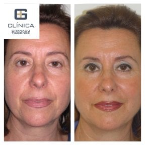 Before and after mini facelift results at Clinica Granado Tiagonce, facial rejuvenation visible