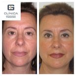 Before and after mini facelift results at Clinica Granado Tiagonce, facial rejuvenation visible
