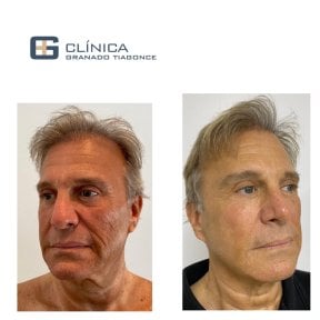 Before and after mini facelift results at Clinica Granado Tiagonce, facial rejuvenation visible