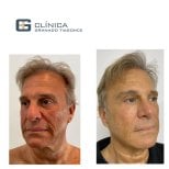 Before and after mini facelift results at Clinica Granado Tiagonce, facial rejuvenation visible