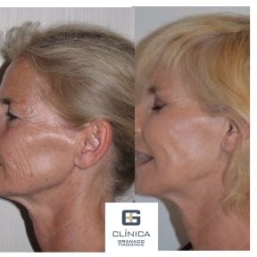 Before and after mini facelift results at Clinica Granado Tiagonce, visible facial rejuvenation