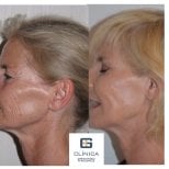 Before and after mini facelift results at Clinica Granado Tiagonce, visible facial rejuvenation