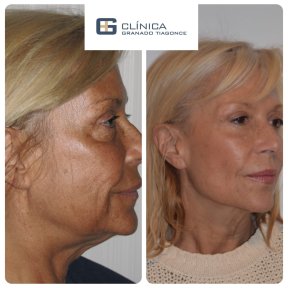 Before and after mini facelift results at Clinica Granado Tiagonce, facial rejuvenation visible