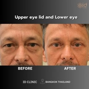 Before and after upper and lower eyelid surgery results at ID Clinic Bangkok