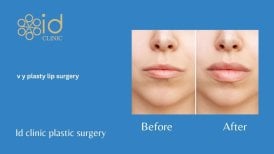 نتائج قبل وبعد جراحة شفاه V-Y بلاستي في ID Clinic Bangkok، شفاه أكثر امتلاءً