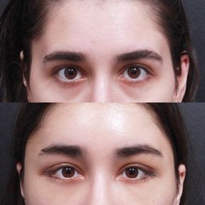 Результаты блефаропластики до и после в VG Plastic Surgery, коррекция век