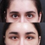 Результаты блефаропластики до и после в VG Plastic Surgery, коррекция век