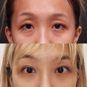 Результаты блефаропластики до и после в VG Plastic Surgery, коррекция век