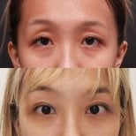Результаты блефаропластики до и после в VG Plastic Surgery, коррекция век