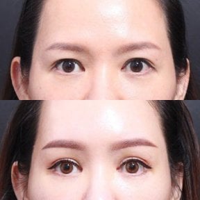 Результаты блефаропластики до и после в VG Plastic Surgery, коррекция век