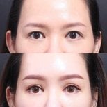 Результаты блефаропластики до и после в VG Plastic Surgery, коррекция век