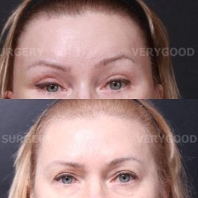 Результаты блефаропластики век до и после в VG Plastic Surgery, коррекция верхних век