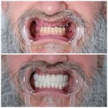 نتائج زراعة الأسنان الفورية في YEG Clinic – استعادة الابتسامة الكاملة