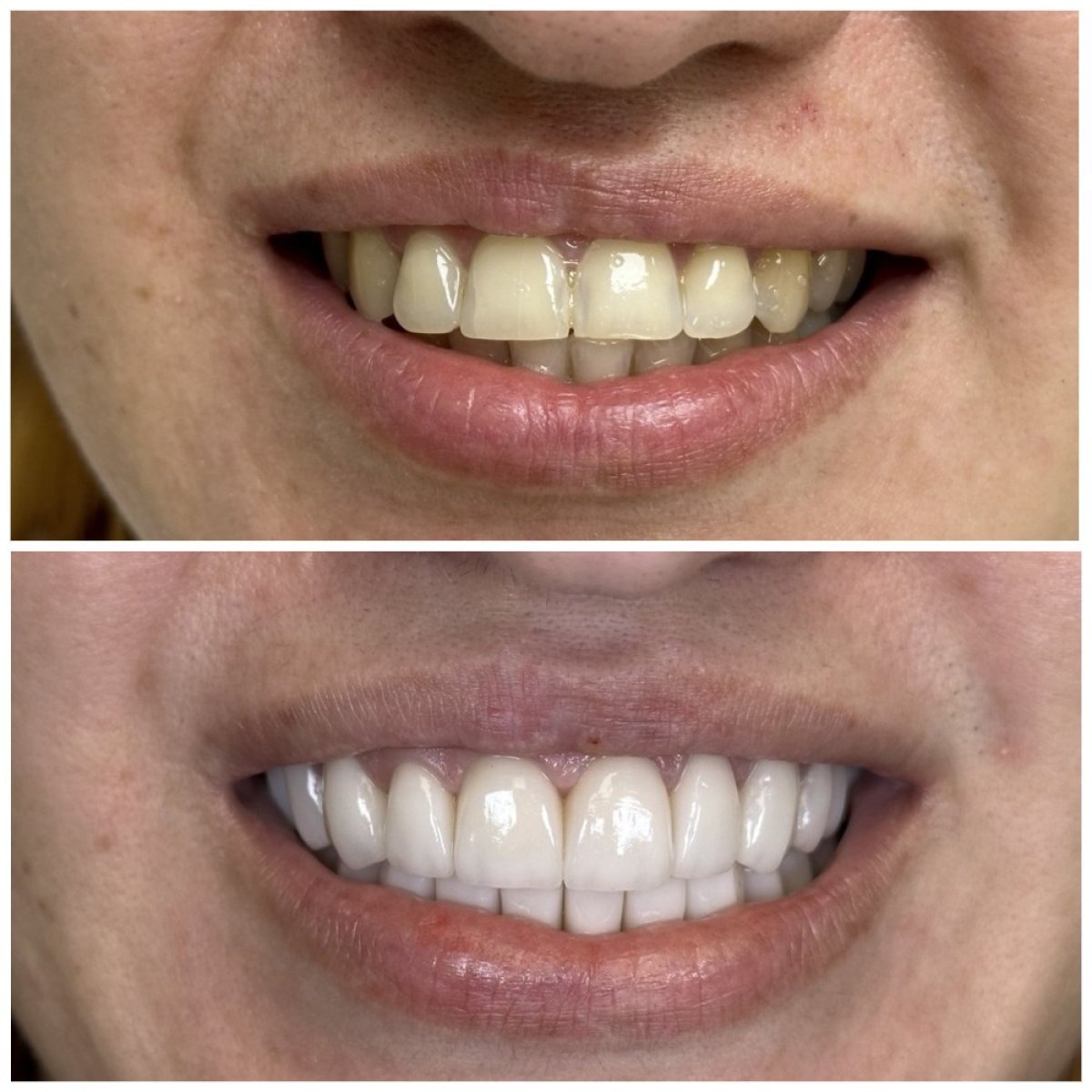 نتائج قبل وبعد ترابط الأسنان في VerMax Dental Clinic – تحسين جمالية الابتسامة