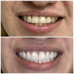Before and after dental bonding results at VerMax Dental Clinic – improved smile aesthetics