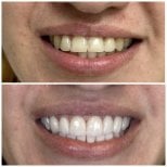Before and after dental bonding results at VerMax Dental Clinic – improved smile aesthetics