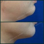 نتائج شفط الدهون للذقن والرقبة قبل وبعد في SAERO Plastic Surgery