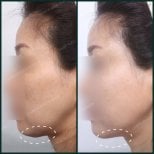 نتائج شفط الدهون قبل وبعد في SAERO Plastic Surgery، تحسين تحديد الفك