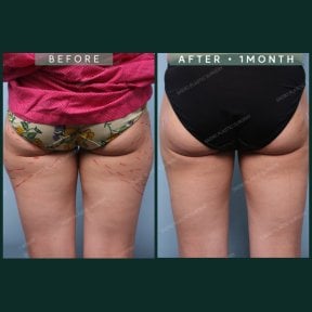 نتائج شفط الدهون قبل وبعد في SAERO Plastic Surgery – أفخاذ وأرداف أنحف