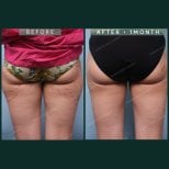 نتائج شفط الدهون قبل وبعد في SAERO Plastic Surgery – أفخاذ وأرداف أنحف