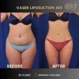 Vaser liposuction 360 before and after results at ID Clinic Bangkok, visible body contouring